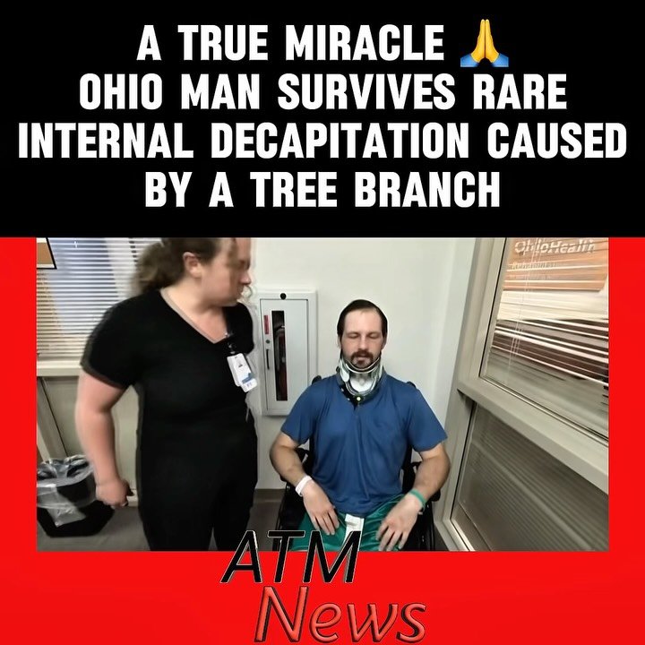 Philip Pohle, 32, was clearing debris at #Ohio’s Hocking Hills State Park in March when a fallen tree branch almost killed him.—As he tried to push the branch off the road, it fell onto his neck. His foot was stuck to the gas pedal, pushing the branch further and further into his neck. He said, "I heard a pop or a crack like that, and I had a decapitation." Thinking he was going to die, he said, he began thinking about his #children.—Fortunately, his co-worker quickly called for help, and emergency crews arrived within 20 minutes. At the hospital, #neurosurgeon Dr. Victor Awuor determined that Pohle suffered from what is known as an internal decapitation. He revealed that the space between the skull and the spine is supposed to be only 2mm wide, but Pohle’s was 9mm after the #accident. Dr. Awuor added that had the branch pushed that distance by two extra millimeters, Pohle would have been paralyzed from the neck down. He said that 50% of patients immediately die from such injury, and out of the remaining 50% who do survive, the majority are paralyzed. So, for Pohle to survive it and retain the ability to walk, it is a true #miracle. —Pohle advises everyone to love deeply because tomorrow is not promised.—🎥 @wbns10tv